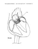 Actively Controllable Stent, Stent Graft, Heart Valve and Method of     Controlling Same diagram and image