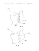 Heart Valve Assemblies and methods for using them diagram and image