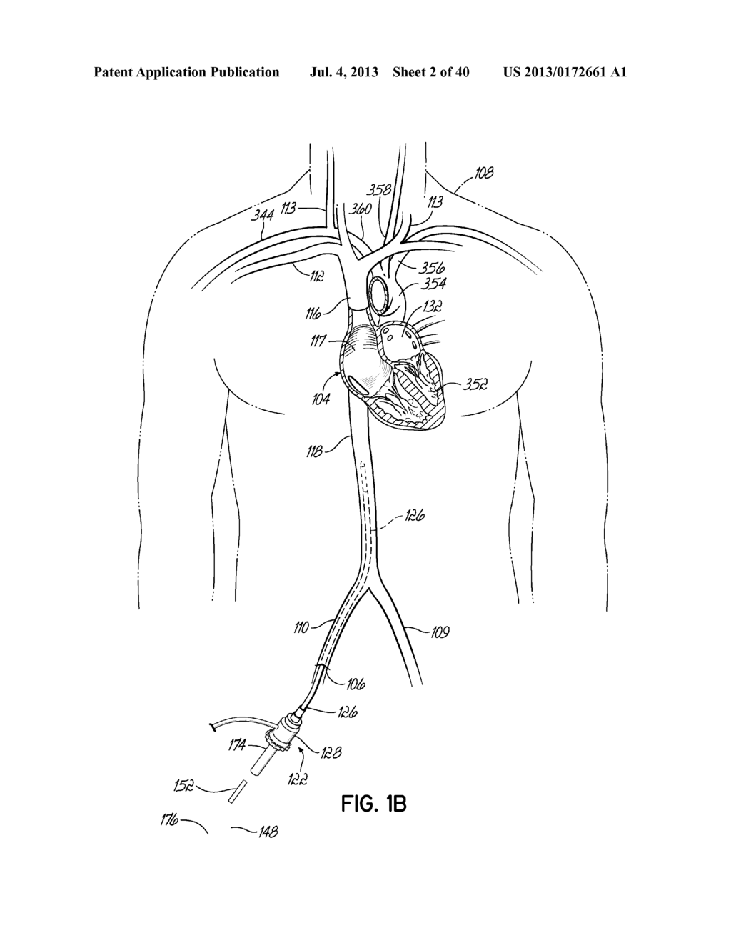 TRANSSEPTAL CANNULA, TIP, DELIVERY SYSTEM, AND METHOD - diagram, schematic, and image 03