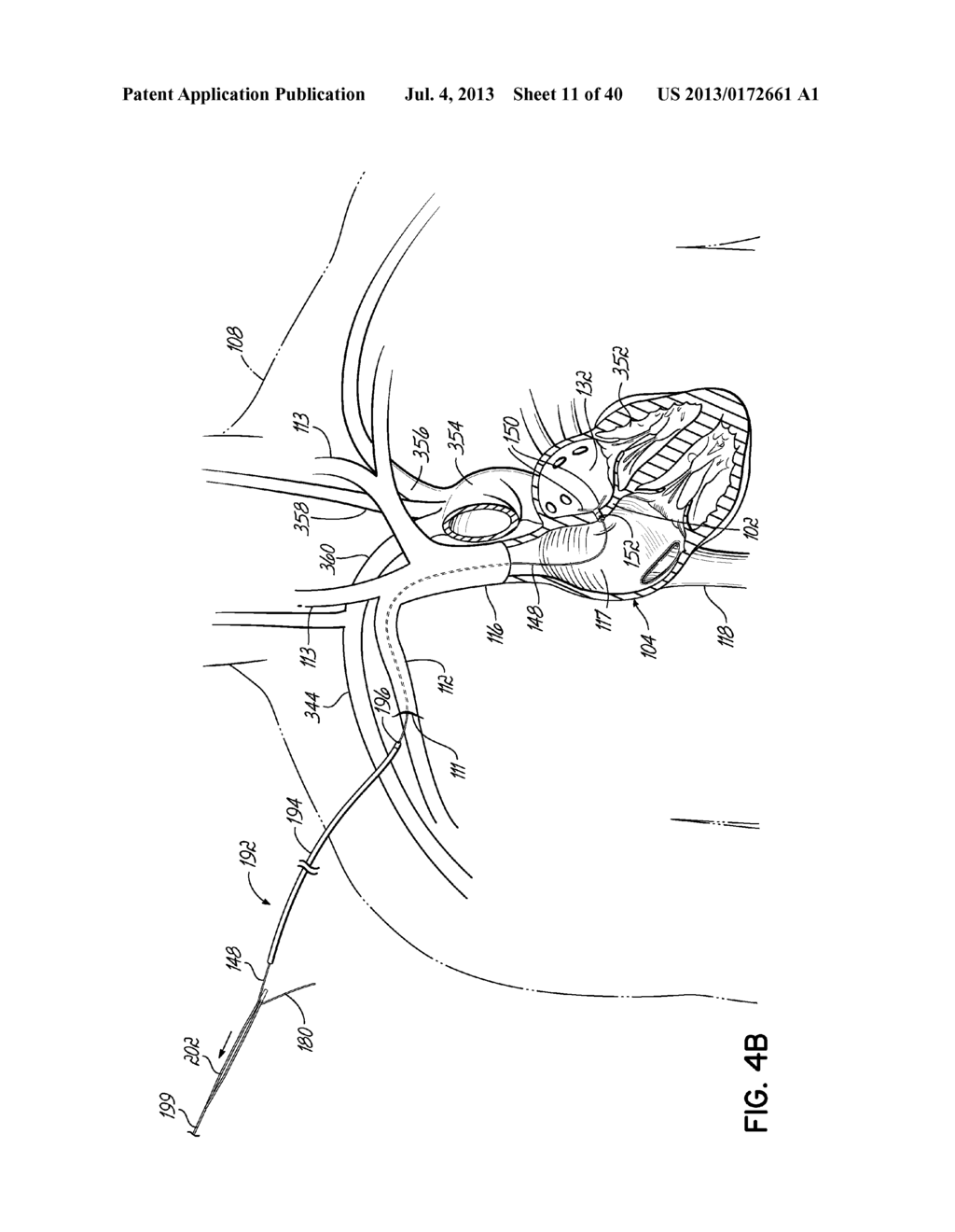 TRANSSEPTAL CANNULA, TIP, DELIVERY SYSTEM, AND METHOD - diagram, schematic, and image 12