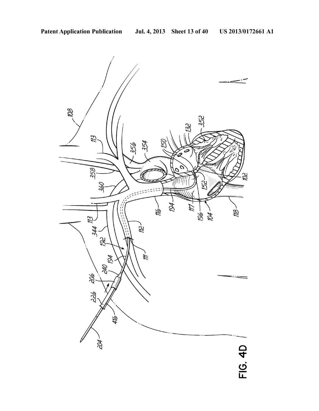 TRANSSEPTAL CANNULA, TIP, DELIVERY SYSTEM, AND METHOD - diagram, schematic, and image 14