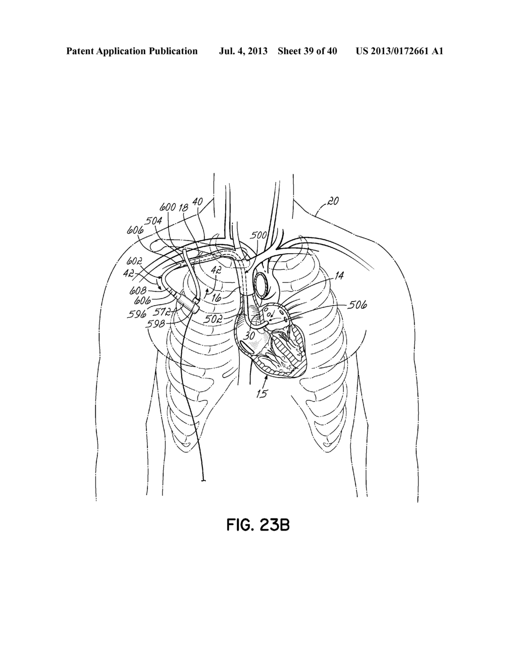 TRANSSEPTAL CANNULA, TIP, DELIVERY SYSTEM, AND METHOD - diagram, schematic, and image 40