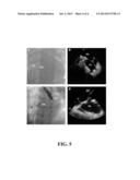 Trans-septal Puncture Catheter Incorporating Intra-cardiac     Echocardiography diagram and image