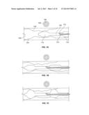 ENDOLUMINAL DELIVERY OF ANESTHESIA diagram and image