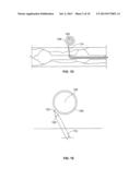 ENDOLUMINAL DELIVERY OF ANESTHESIA diagram and image