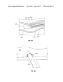 ENDOLUMINAL DELIVERY OF ANESTHESIA diagram and image