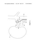 RENAL NERVE MODULATION DEVICES AND METHODS FOR RENAL NERVE MODULATION diagram and image