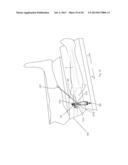 Suprapatellar Insertion System, Kit and Method diagram and image