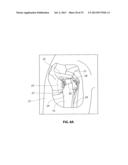 ANATOMICAL LOCATION MARKERS AND METHODS OF USE IN POSITIONING SHEET-LIKE     MATERIALS DURING SURGERY diagram and image