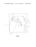 ANATOMICAL LOCATION MARKERS AND METHODS OF USE IN POSITIONING SHEET-LIKE     MATERIALS DURING SURGERY diagram and image