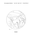 ANATOMICAL LOCATION MARKERS AND METHODS OF USE IN POSITIONING SHEET-LIKE     MATERIALS DURING SURGERY diagram and image