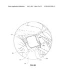 ANATOMICAL LOCATION MARKERS AND METHODS OF USE IN POSITIONING SHEET-LIKE     MATERIALS DURING SURGERY diagram and image