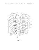 SYSTEM AND METHOD FOR CORRECTION OF A SPINAL DISORDER diagram and image