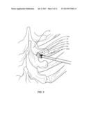 SYSTEM AND METHOD FOR CORRECTION OF A SPINAL DISORDER diagram and image