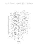 SYSTEM AND METHOD FOR CORRECTION OF A SPINAL DISORDER diagram and image