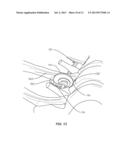 SYSTEM AND METHOD FOR CORRECTION OF A SPINAL DISORDER diagram and image