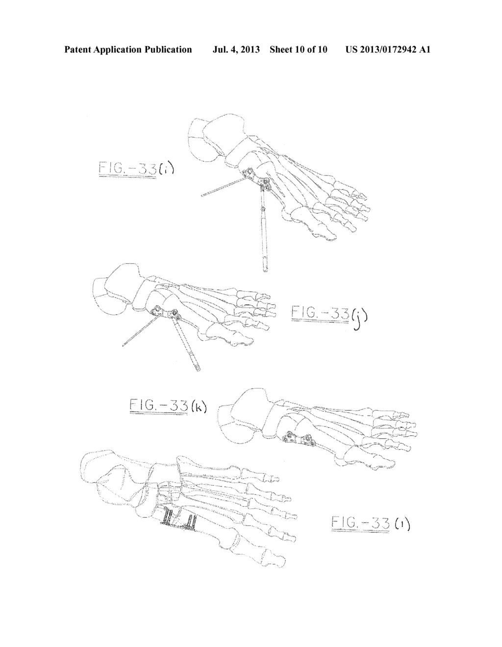 ORTHOPEDIC COMPRESSION PLATE AND METHOD OF SURGERY - diagram, schematic, and image 11