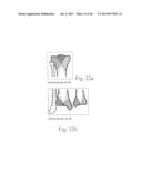 SYSTEMS AND METHODS FOR USING POLYAXIAL PLATES diagram and image