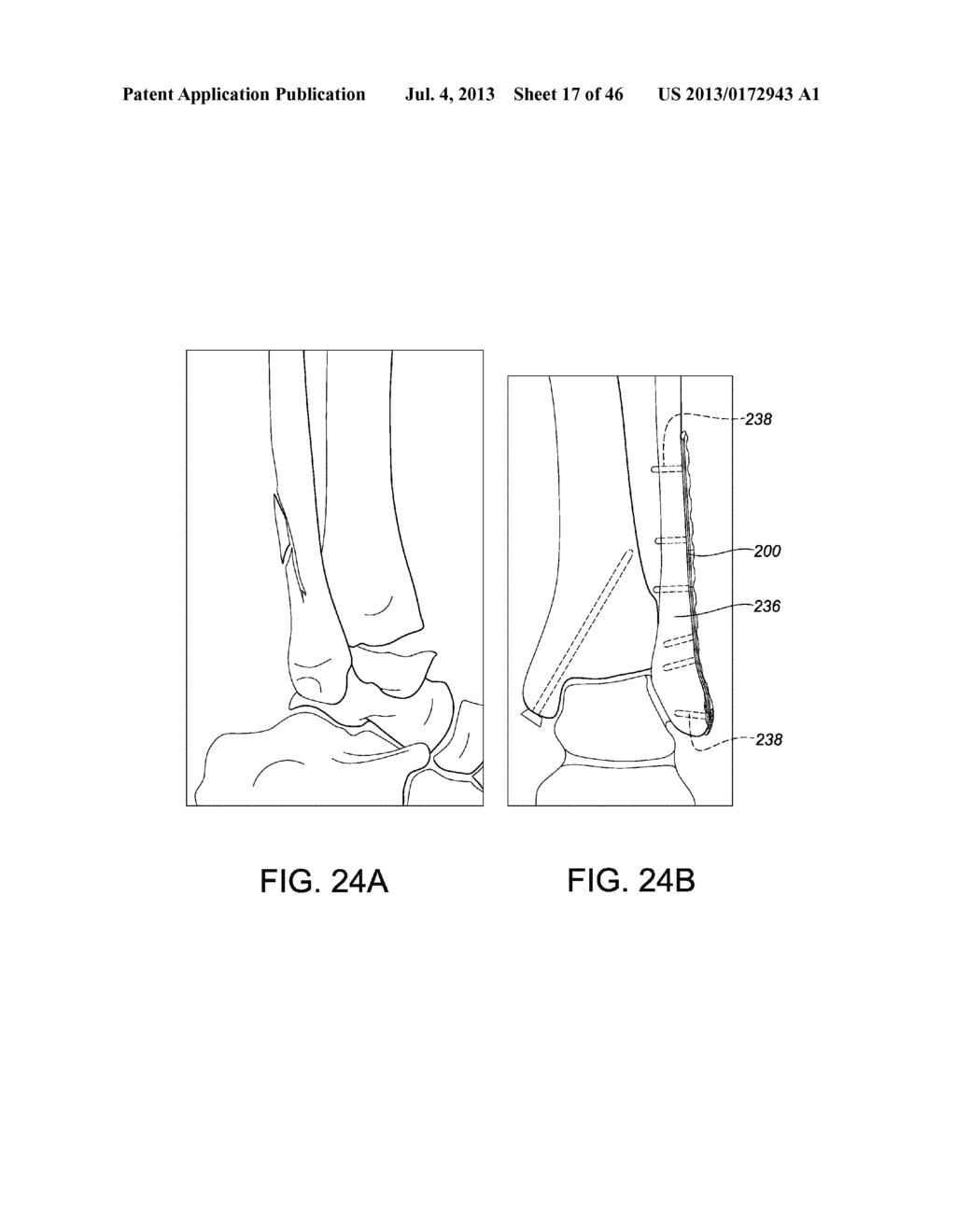 SYSTEMS AND METHODS FOR USING POLYAXIAL PLATES - diagram, schematic, and image 18