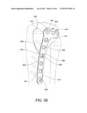 SYSTEMS AND METHODS FOR USING POLYAXIAL PLATES diagram and image