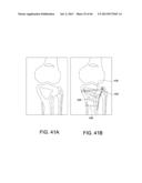 SYSTEMS AND METHODS FOR USING POLYAXIAL PLATES diagram and image