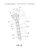 SYSTEMS AND METHODS FOR USING POLYAXIAL PLATES diagram and image