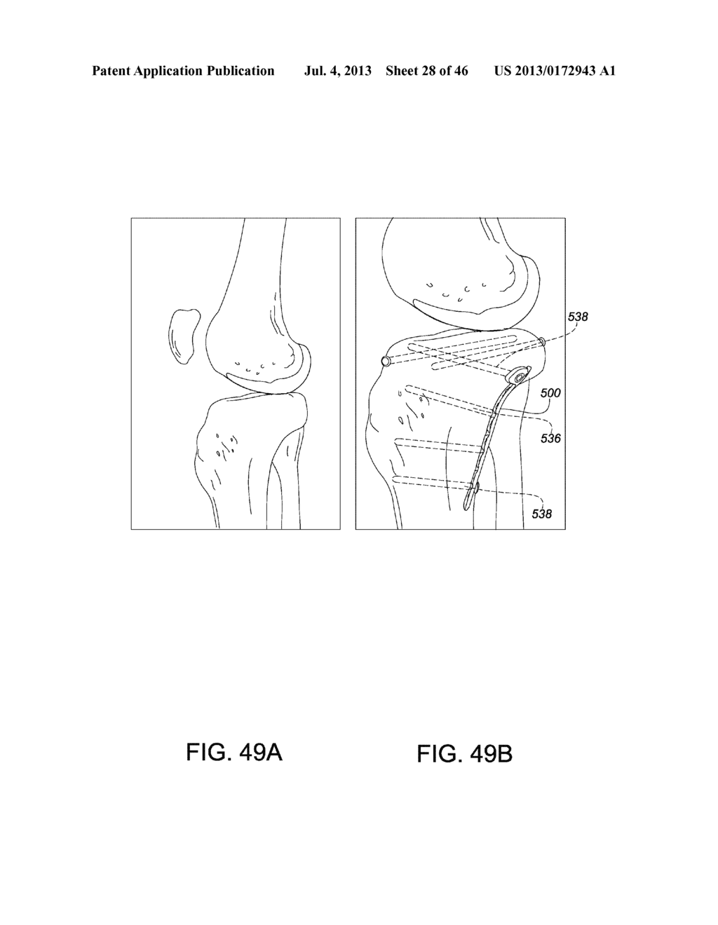 SYSTEMS AND METHODS FOR USING POLYAXIAL PLATES - diagram, schematic, and image 29