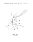 SYSTEMS AND METHODS FOR USING POLYAXIAL PLATES diagram and image