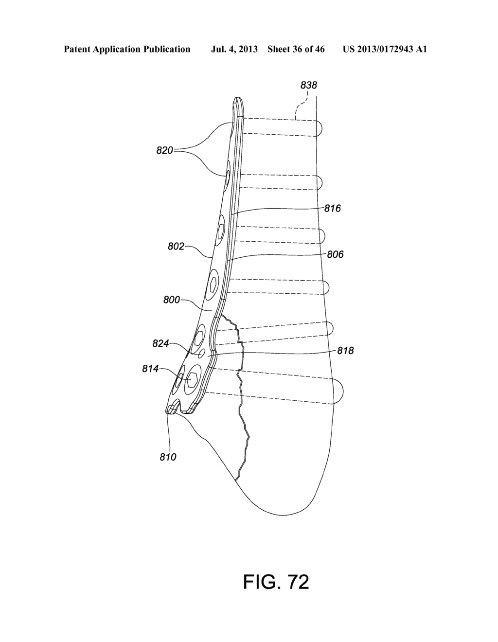 SYSTEMS AND METHODS FOR USING POLYAXIAL PLATES - diagram, schematic, and image 37