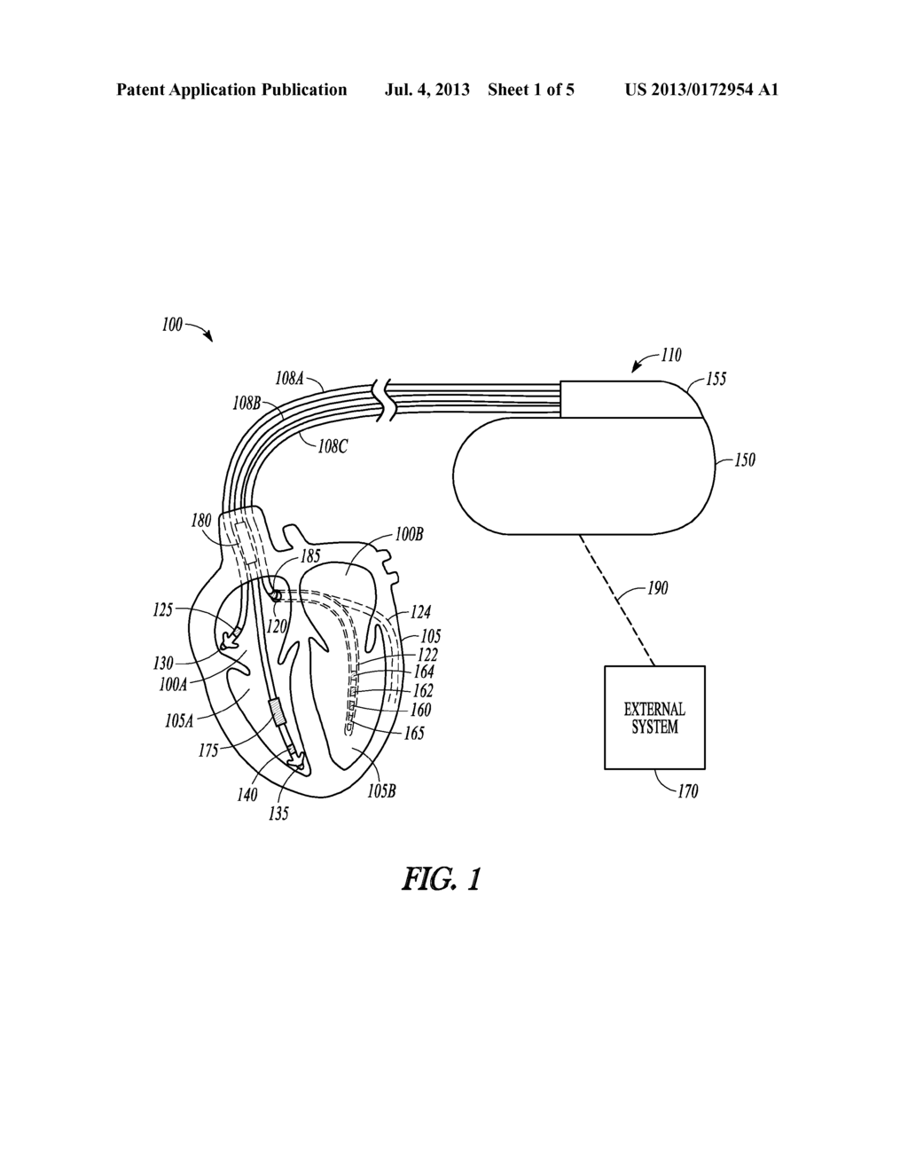 APPARATUSES AND METHODS USING THE ROLE OF VENTRICULAR ELECTRICAL DELAY TO     PREDICT LEFT VENTRICULAR REMODELING WITH CARDIAC RESYNCHRONIZATION     THERAPY - diagram, schematic, and image 02