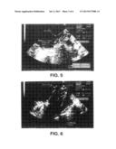 IMPLANTABLE PRODUCT WITH IMPROVED AQUEOUS INTERFACE CHARACTERISTICS AND     METHODS FOR MAKING AND USING THE SAME diagram and image