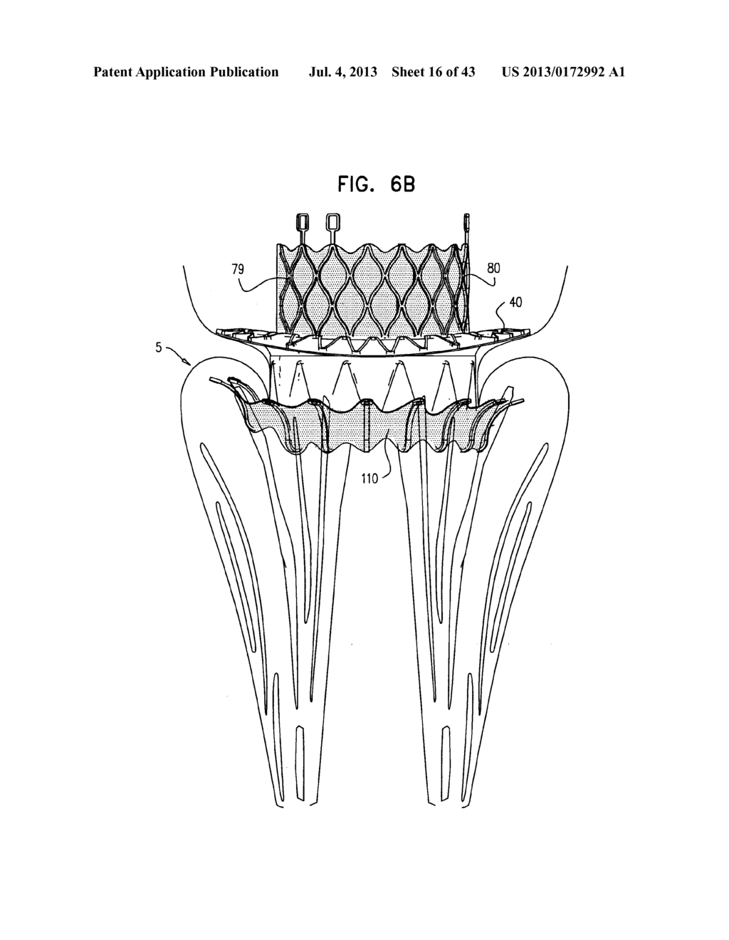 TECHNIQUES FOR PERCUTANEOUS MITRAL VALVE REPLACEMENT AND SEALING - diagram, schematic, and image 17