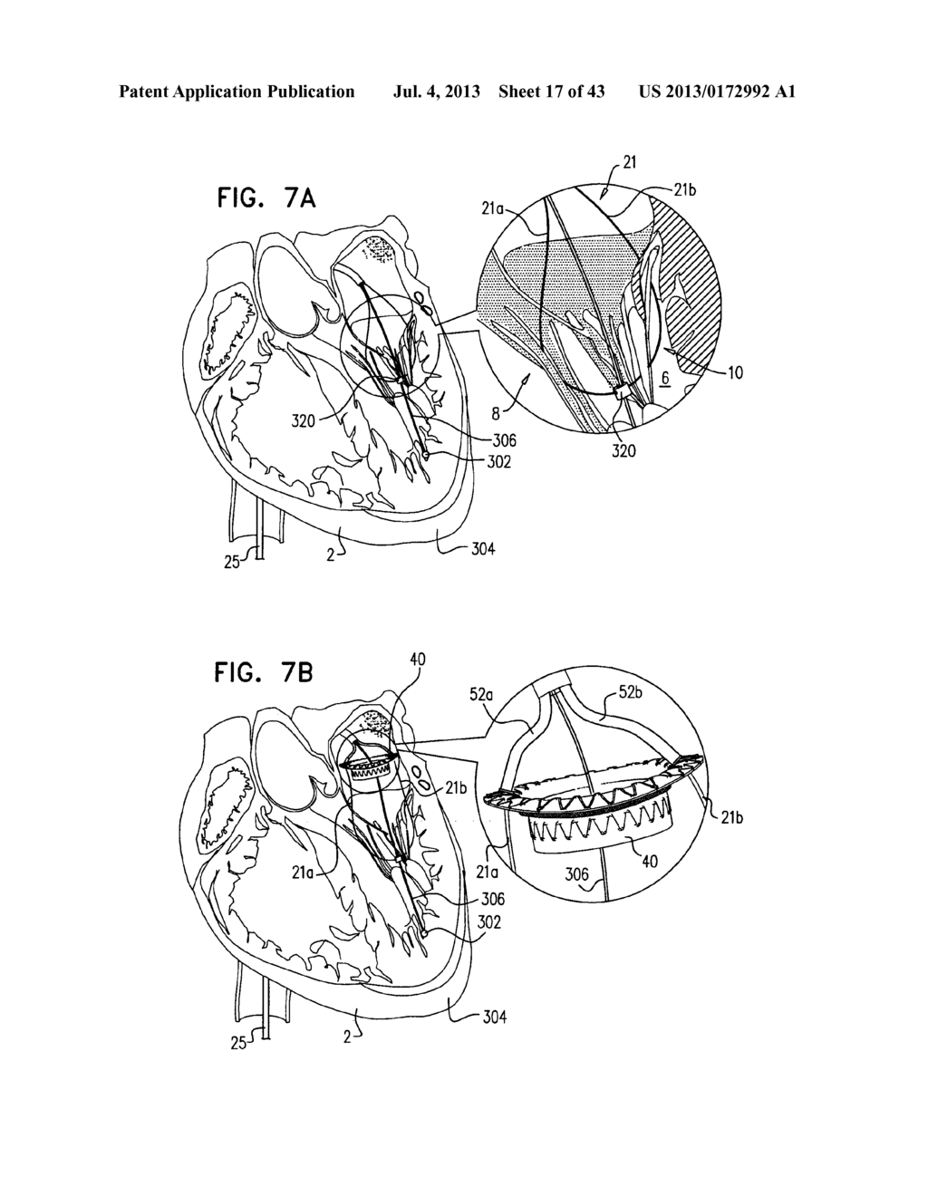 TECHNIQUES FOR PERCUTANEOUS MITRAL VALVE REPLACEMENT AND SEALING - diagram, schematic, and image 18