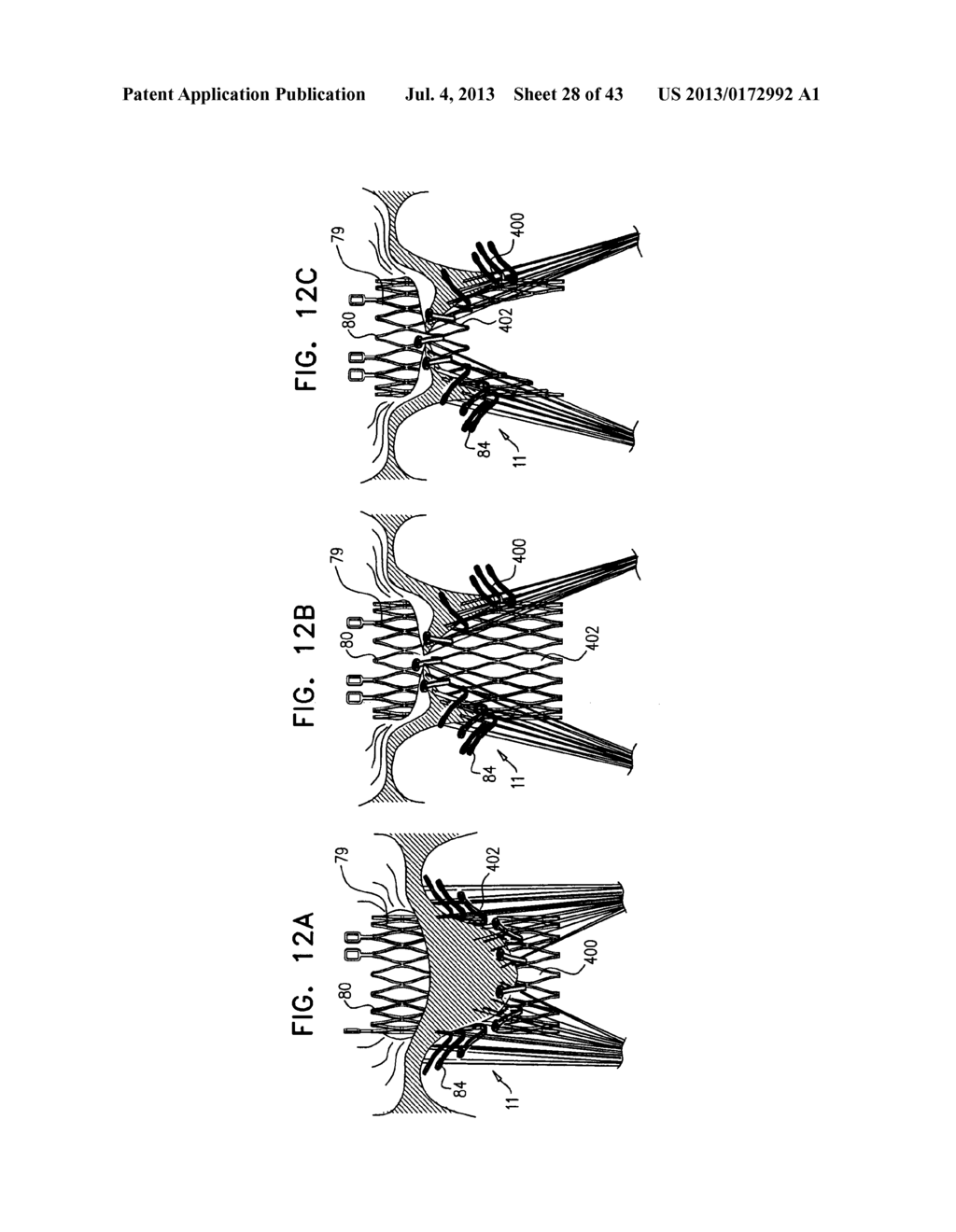 TECHNIQUES FOR PERCUTANEOUS MITRAL VALVE REPLACEMENT AND SEALING - diagram, schematic, and image 29