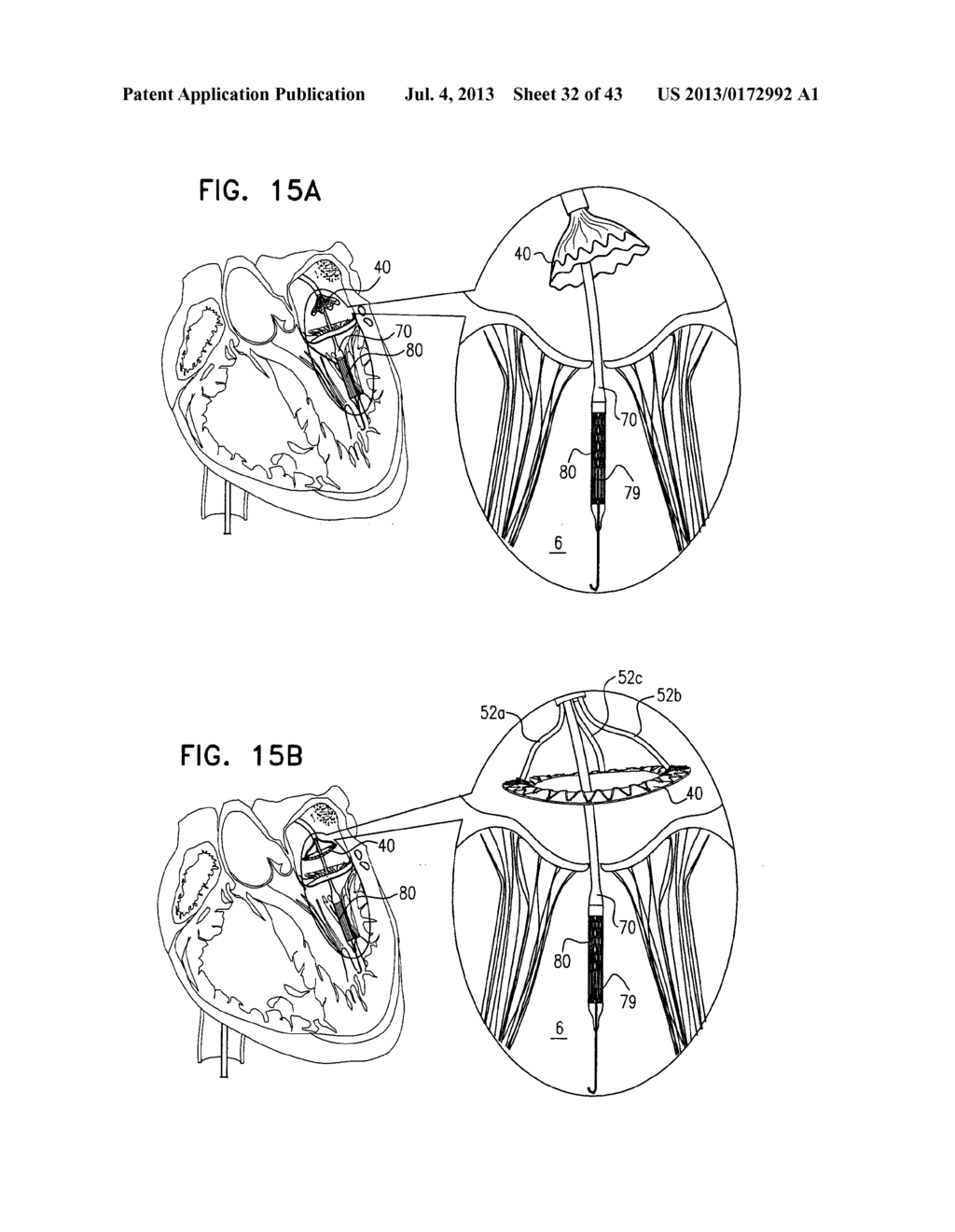 TECHNIQUES FOR PERCUTANEOUS MITRAL VALVE REPLACEMENT AND SEALING - diagram, schematic, and image 33