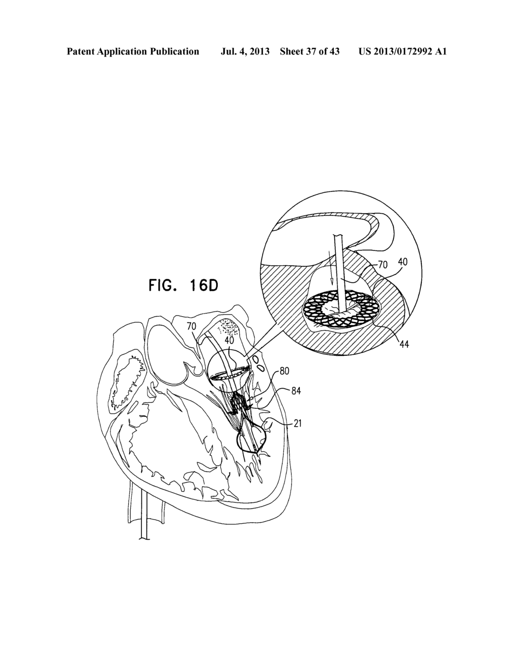 TECHNIQUES FOR PERCUTANEOUS MITRAL VALVE REPLACEMENT AND SEALING - diagram, schematic, and image 38