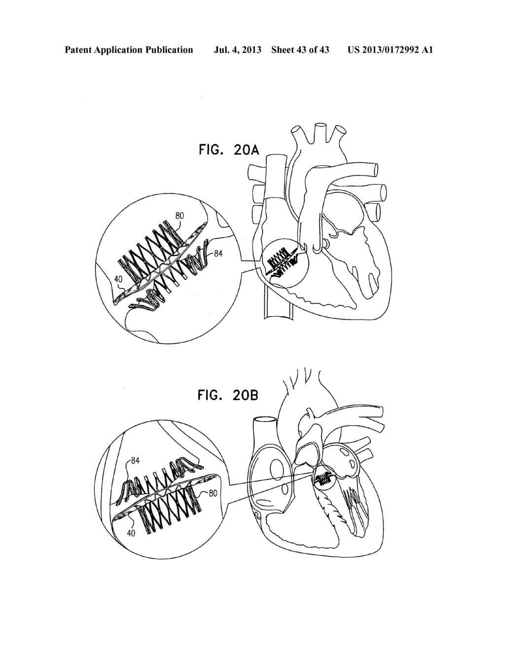 TECHNIQUES FOR PERCUTANEOUS MITRAL VALVE REPLACEMENT AND SEALING - diagram, schematic, and image 44