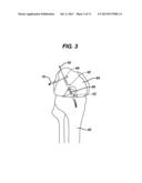 METHODS FOR LIGAMENT RECONSTRUCTION diagram and image