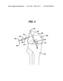 METHODS FOR LIGAMENT RECONSTRUCTION diagram and image