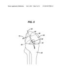 METHODS FOR LIGAMENT RECONSTRUCTION diagram and image