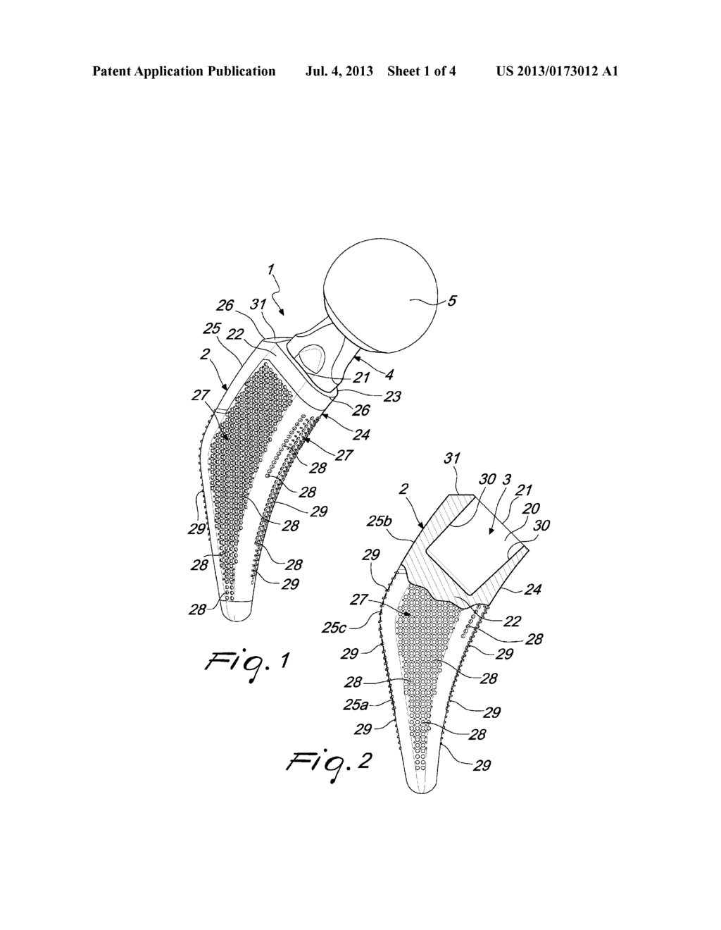 MODULAR PROSTHETIC DEVICE FOR HIP JOINT REPLACEMENT - diagram, schematic, and image 02