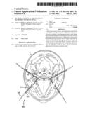 METHODS AND DEVICES FOR TREATMENT OF OBSTRUCTIVE SLEEP APNEA diagram and image