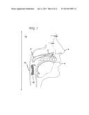 METHODS AND DEVICES FOR TREATMENT OF OBSTRUCTIVE SLEEP APNEA diagram and image