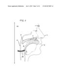 METHODS AND DEVICES FOR TREATMENT OF OBSTRUCTIVE SLEEP APNEA diagram and image