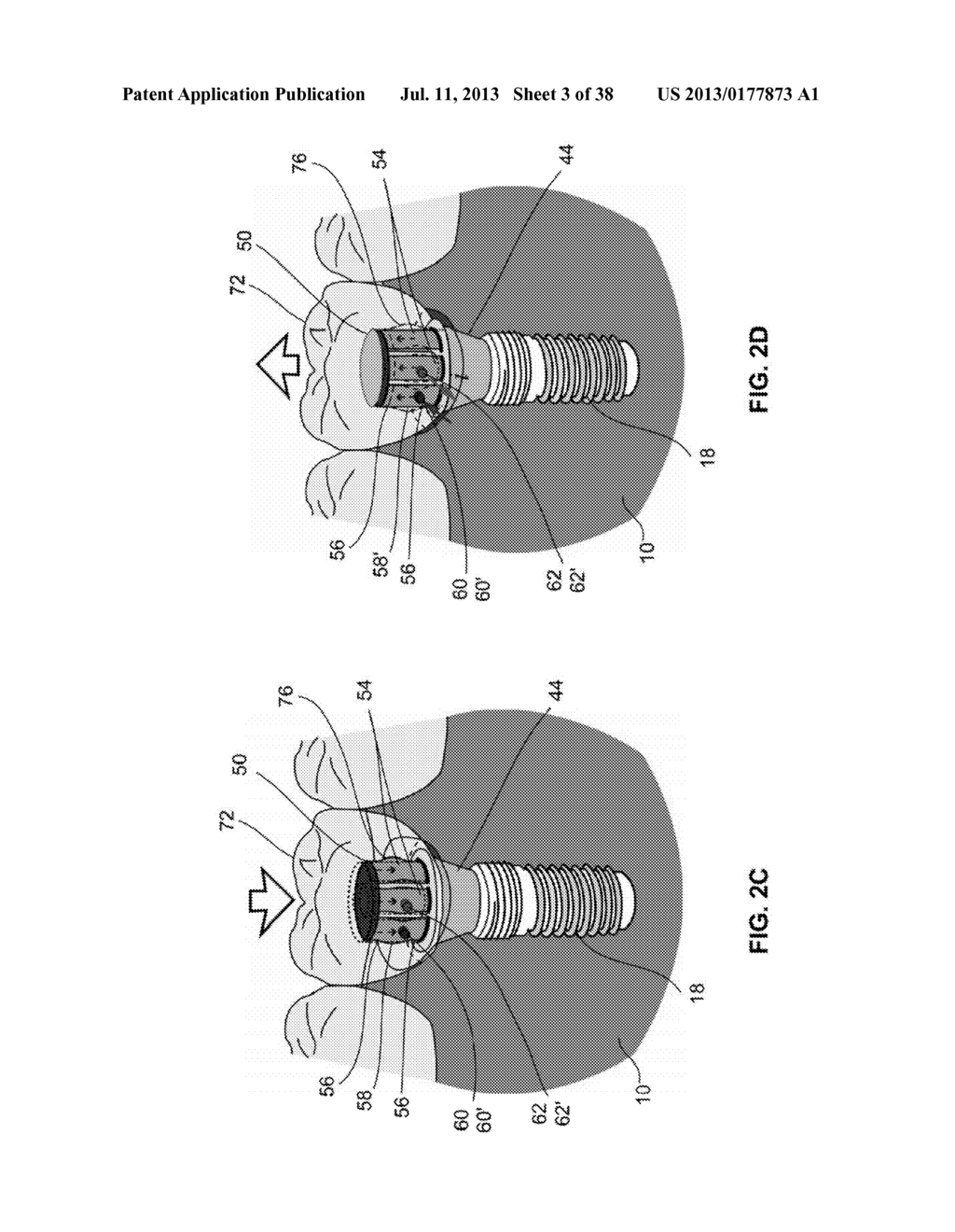 SHAPE MEMORY DENTAL RETENTION SYSTEMS - diagram, schematic, and image 04