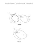 GOLF CLUB HEAD WITH SEPARABLE COMPONENT diagram and image