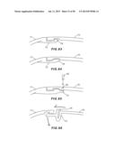 GOLF CLUB HEAD WITH SEPARABLE COMPONENT diagram and image