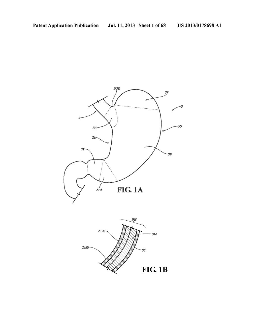 METHODS, INSTRUMENTS AND DEVICES FOR EXTRAGASTIC REDUCTION OF STOMACH     VOLUME - diagram, schematic, and image 02