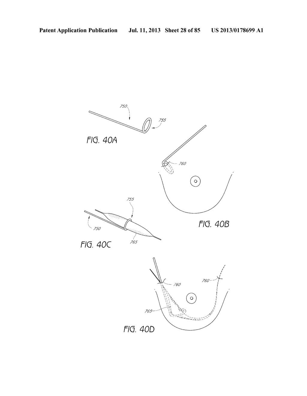 MINIMALLY INVASIVE TISSUE SUPPORT - diagram, schematic, and image 29