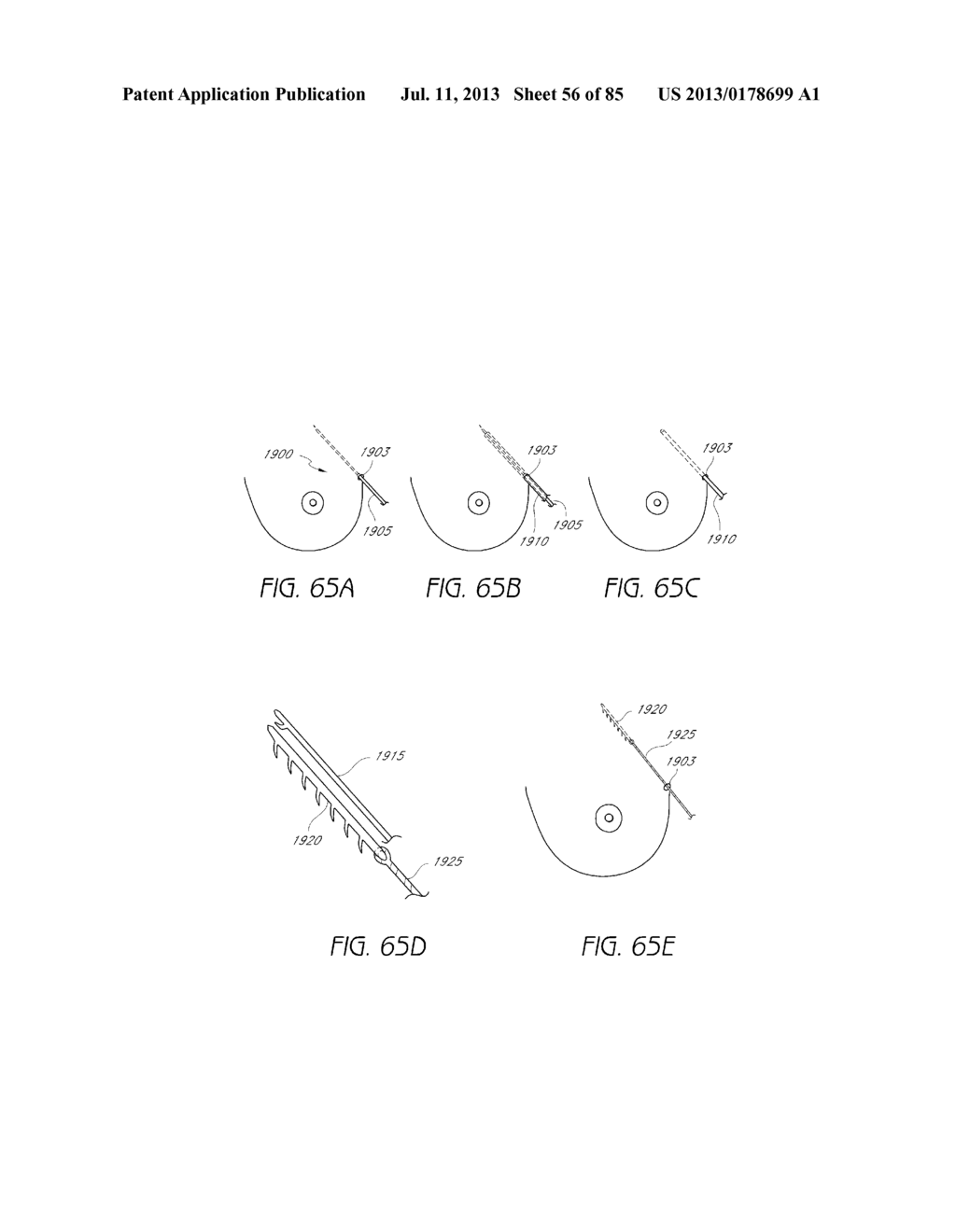 MINIMALLY INVASIVE TISSUE SUPPORT - diagram, schematic, and image 57